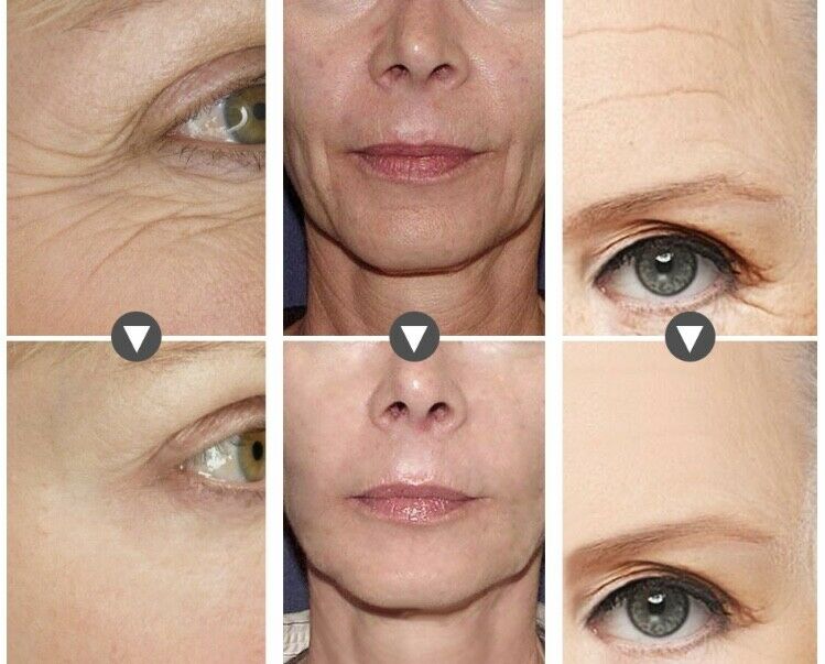 Hyaluronic Acid + Matrixyl 3000 Peptide Serum ,face Eye Anti-aging Wrinkle Serum